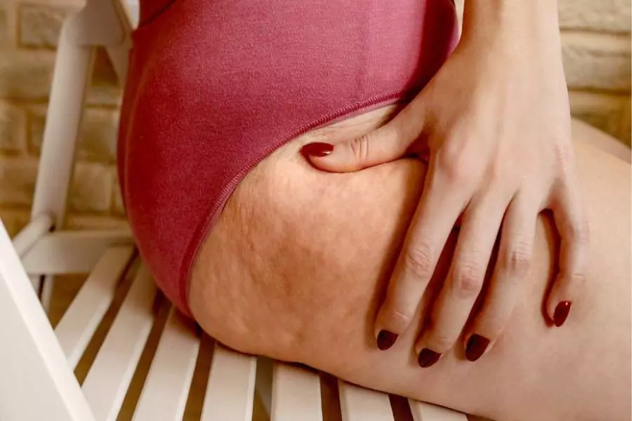 tratamiento contra el lipedema en mujeres. 