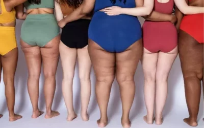 Lipedema: Toda la información que debes conocer