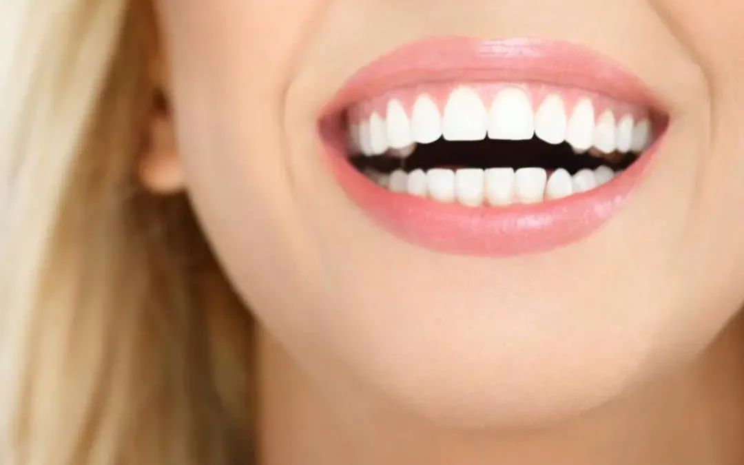 Sonrisa gingival